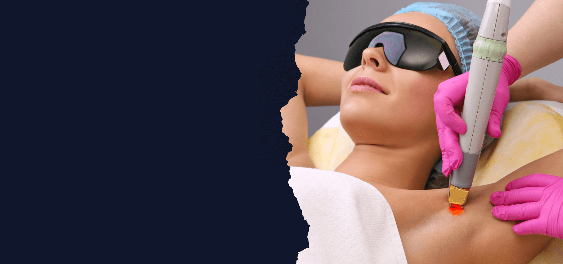 Laser-Hair-removal