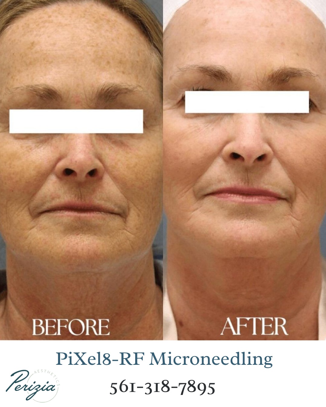 Reveal your best skin yet. Perizia Aesthetics in Jupiter is now offering Pixel8-RF Microneedling – the gold standard in non-surgical skin rejuvenation.
This advanced treatment helps smooth skin, reduce fine lines, refine pores, and provide a natural lift with minimal downtime. Your skin deserves it.
Benefits include:
• Stimulates collagen and elastin
• Improves skin tone and texture
• Reduces fine lines and wrinkles
• Minimizes pores and acne scars
• Lifts and tightens for a more youthful look
RF Microneedling combines the benefits of microneedling with radio frequency energy for smoother, firmer, radiant skin.
Contact us today to schedule your appointment.
