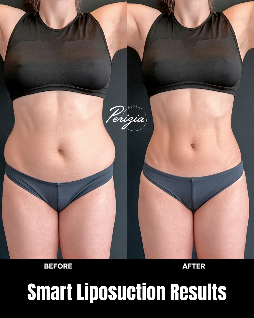 Not all liposuction is created equal.
At Perizia Aesthetics in Jupiter, Dr. Silvestri performs physician-led body sculpting that prioritizes safety, symmetry, and long-term results. His techniques minimize trauma and downtime while achieving detailed contouring — all under expert surgical supervision.
To get liposuction near Jupiter, call us to schedule an appointment.
#LiposuctionExpert #DrFredSilvestri #PeriziaAesthetics #JupiterBodyContour #FloridaAestheticSurgery #SafeLiposuction #PhysicianPerformedLipo
