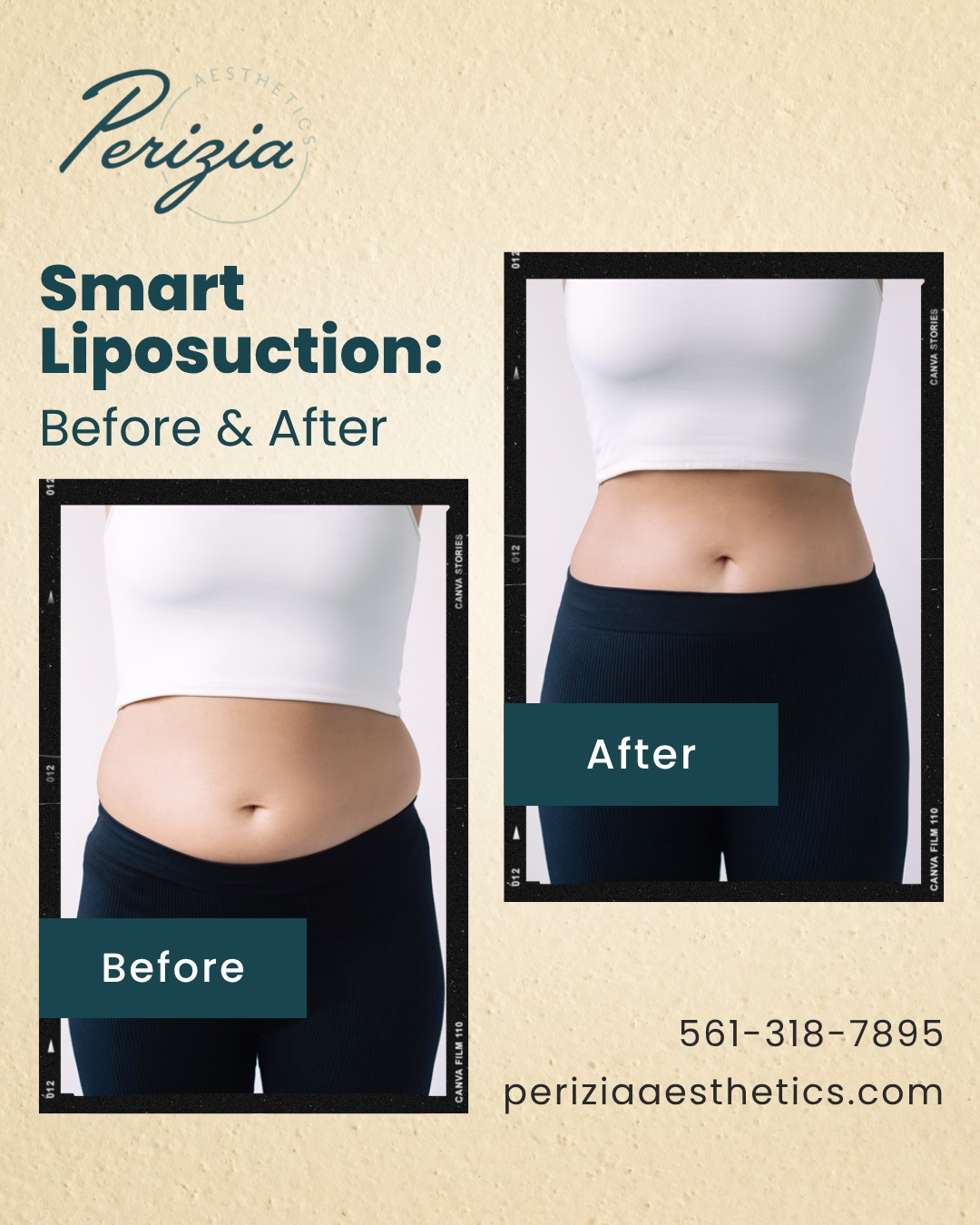 When the gym can’t touch those last few areas, precision can.
Smart Liposuction at Perizia Aesthetics uses advanced technology to gently contour and smooth, enhancing your shape without the downtime of traditional surgery.
Visit us in Jupiter, Florida for a personalized body-sculpting experience that looks and feels completely natural.
#PeriziaAesthetics #SmartLiposuction #JupiterFL #BodyContouring #FloridaAesthetics #RefinedResults