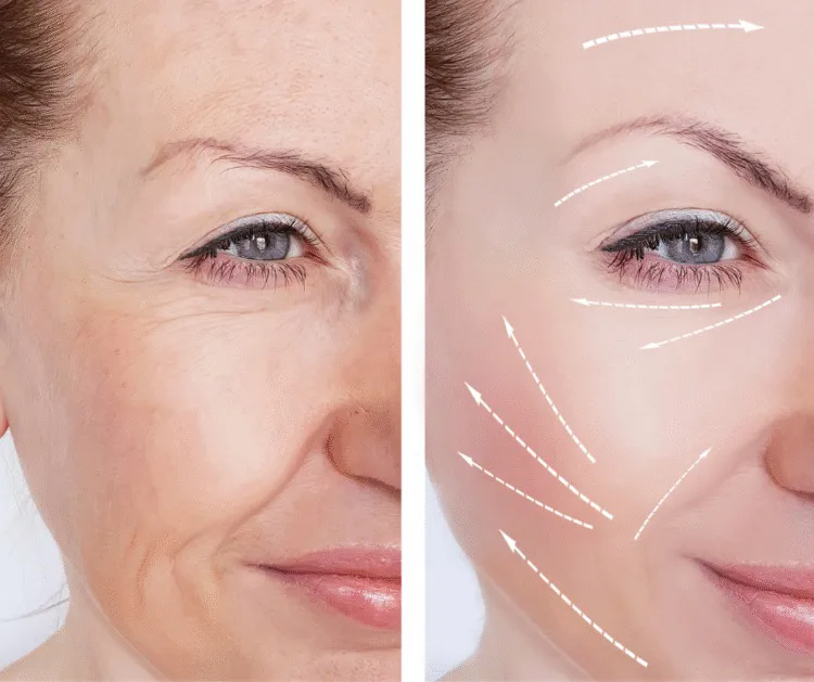 Dermal Filler Before and After