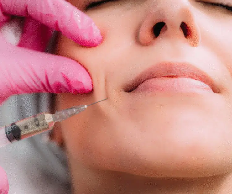 Dermal Filler for Nasolabial Folds (Smile Lines)​