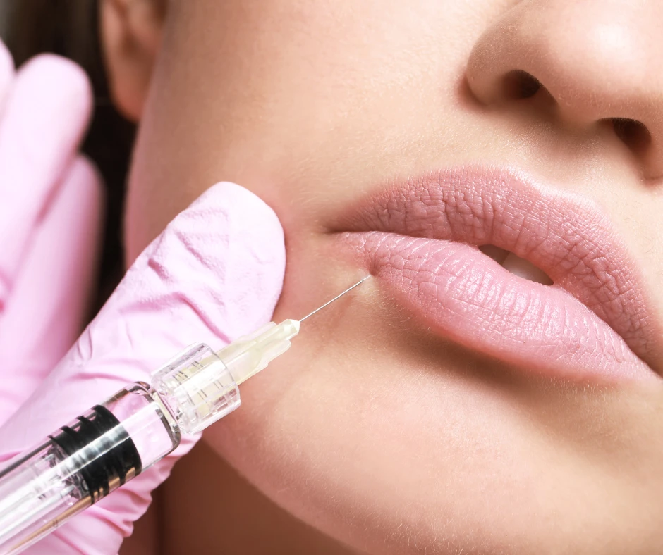 Dermal Fillers for Lips