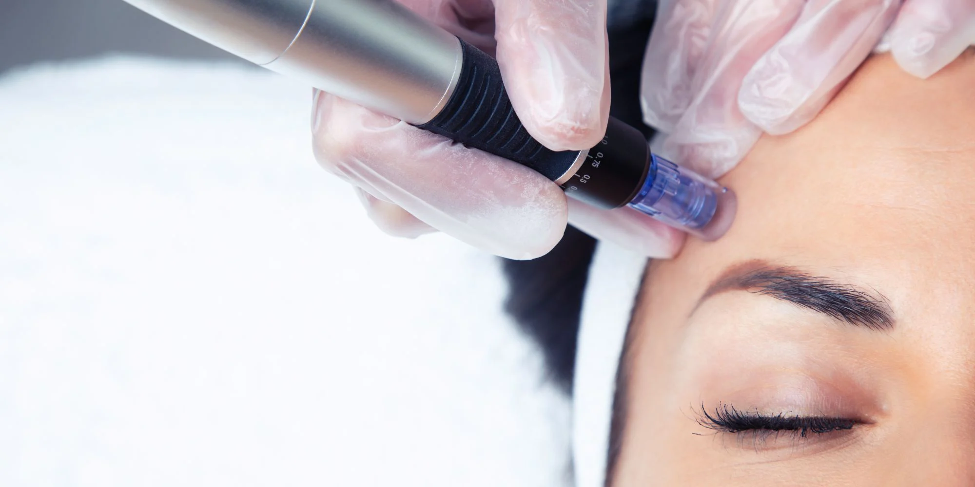 Microneedling