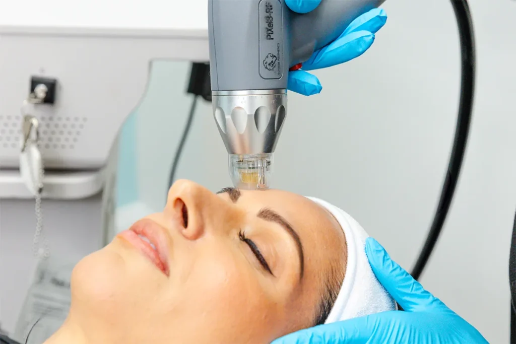 Rf microneedling Treatment Process