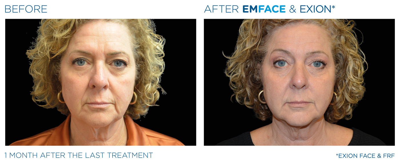 Emface Results Before & After