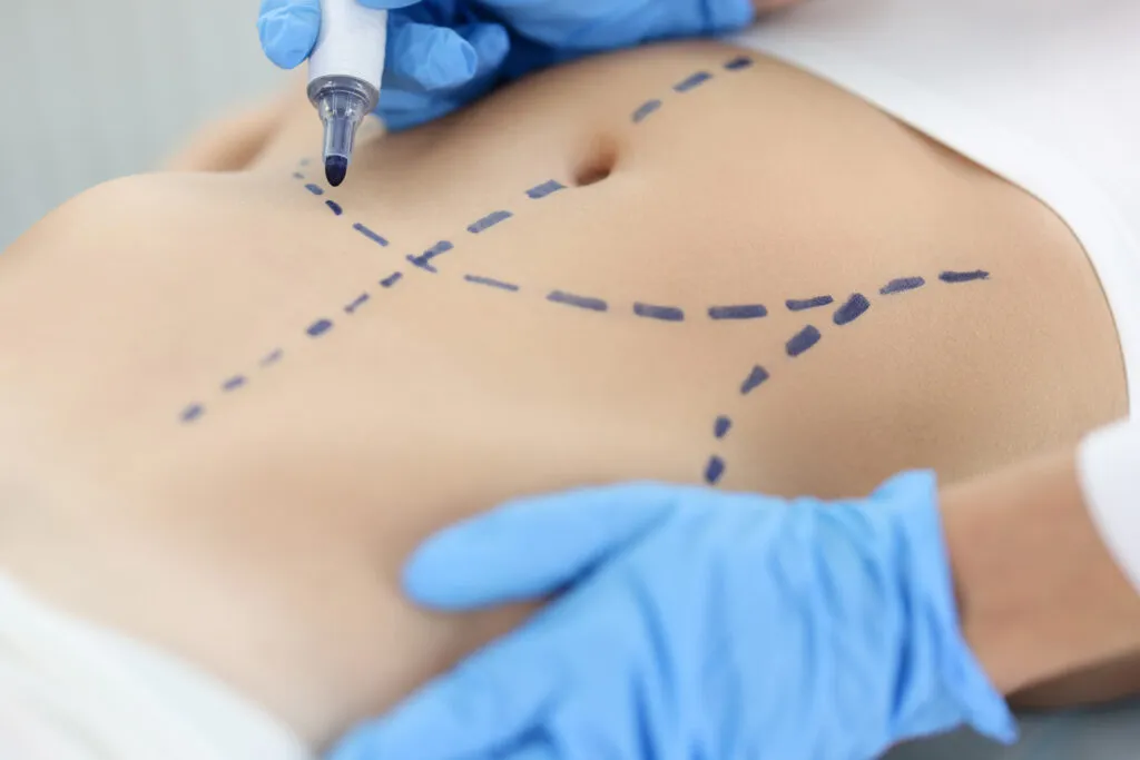 How Smart Liposuction Works​