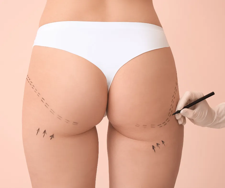Smart Liposuction Designed for the Modern Patient​