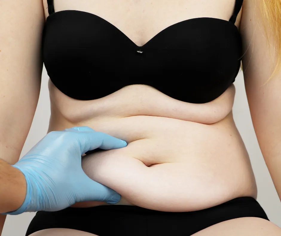 Smart Liposuction for the Abdomen