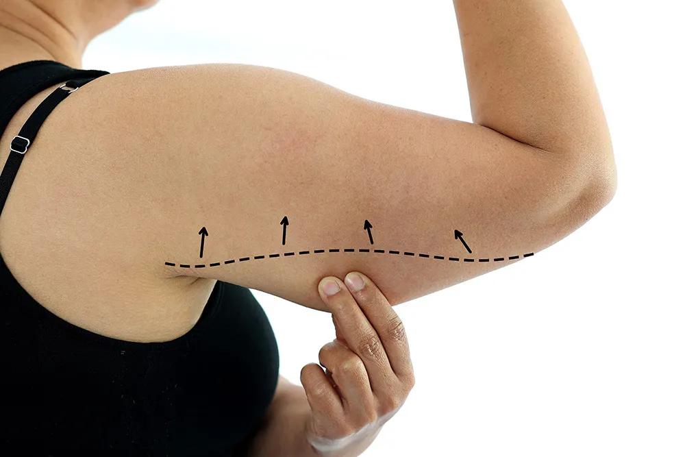 Smart Liposuction for the Arms