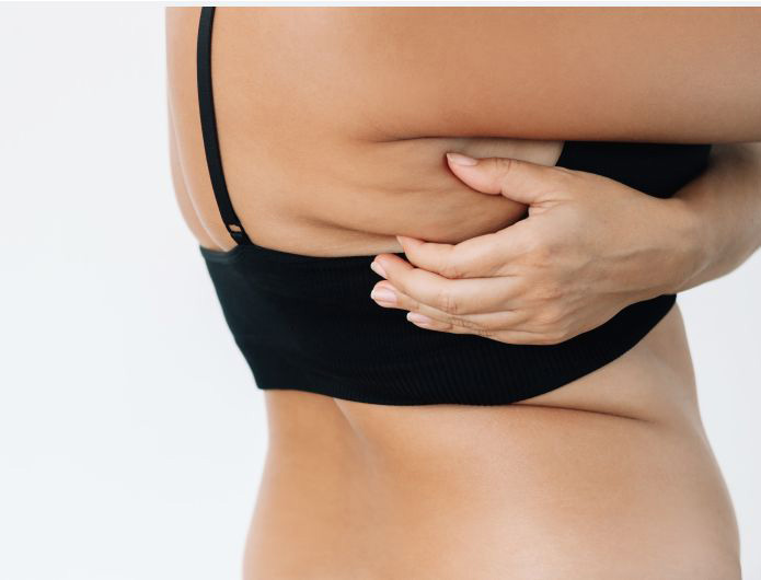 Smart Liposuction for the Back & Bra Line