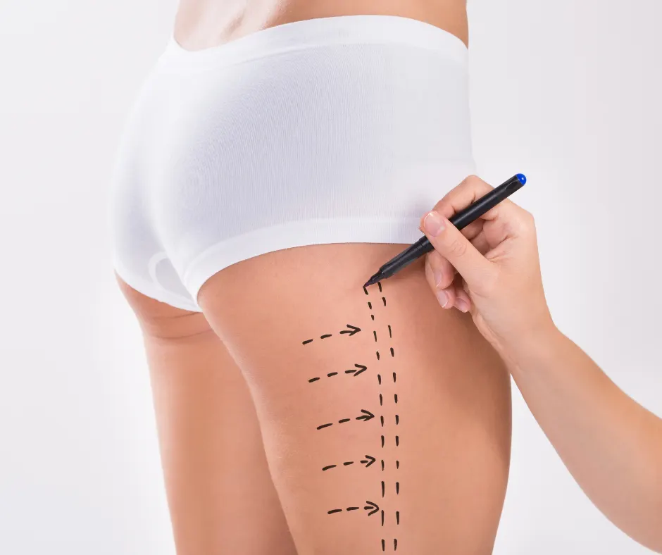 Smart Liposuction Jupiter