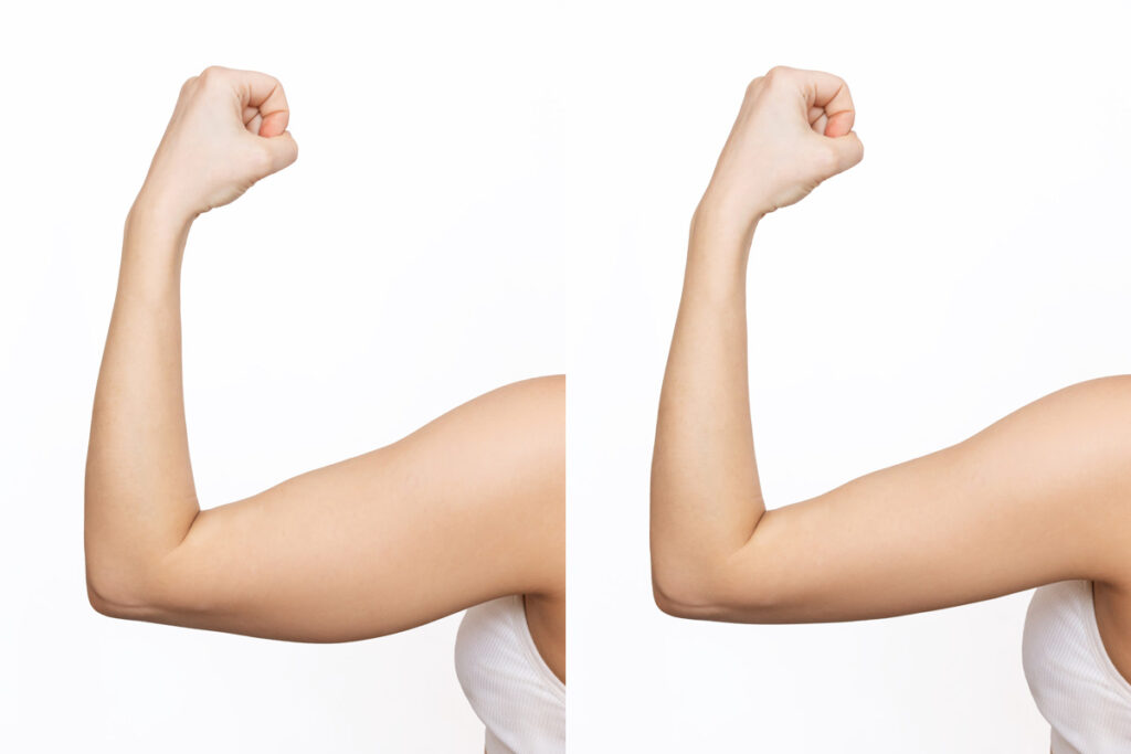 Arm Liposuction Results