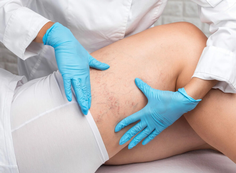 How to Prepare for Sclerotherapy