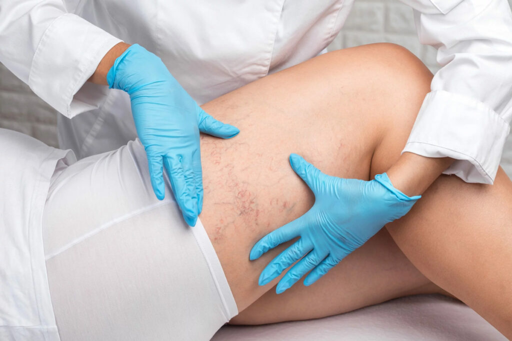 How to Prepare for Sclerotherapy
