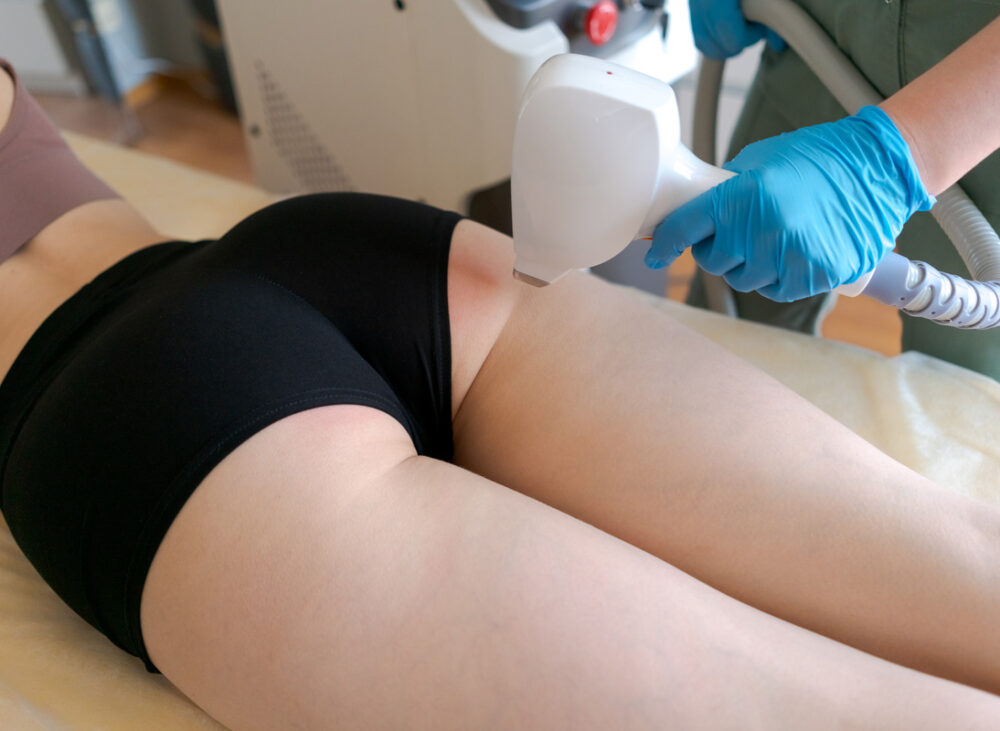 Laser Hair Removal for the Buttocks in Jupiter