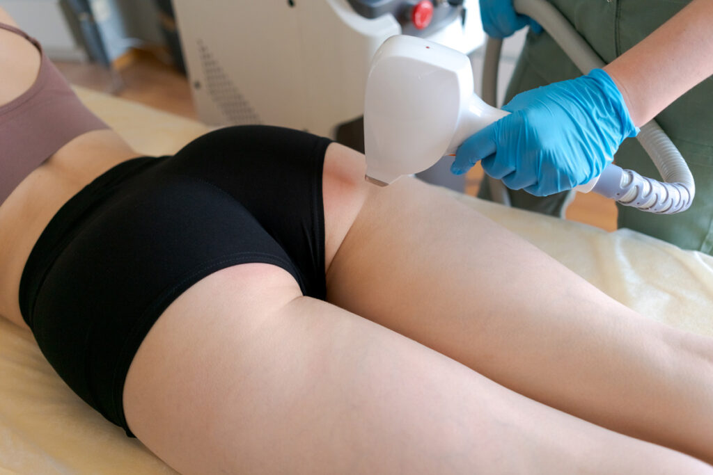 Laser Hair Removal for the Buttocks in Jupiter
