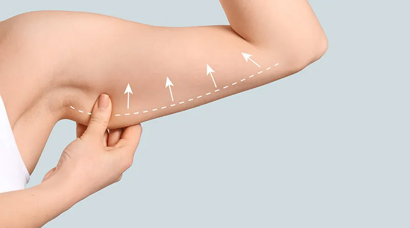 Liposuction vs. Arm Lift