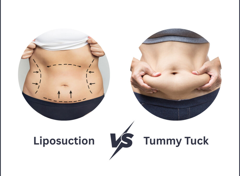 Liposuction vs. Tummy Tuck