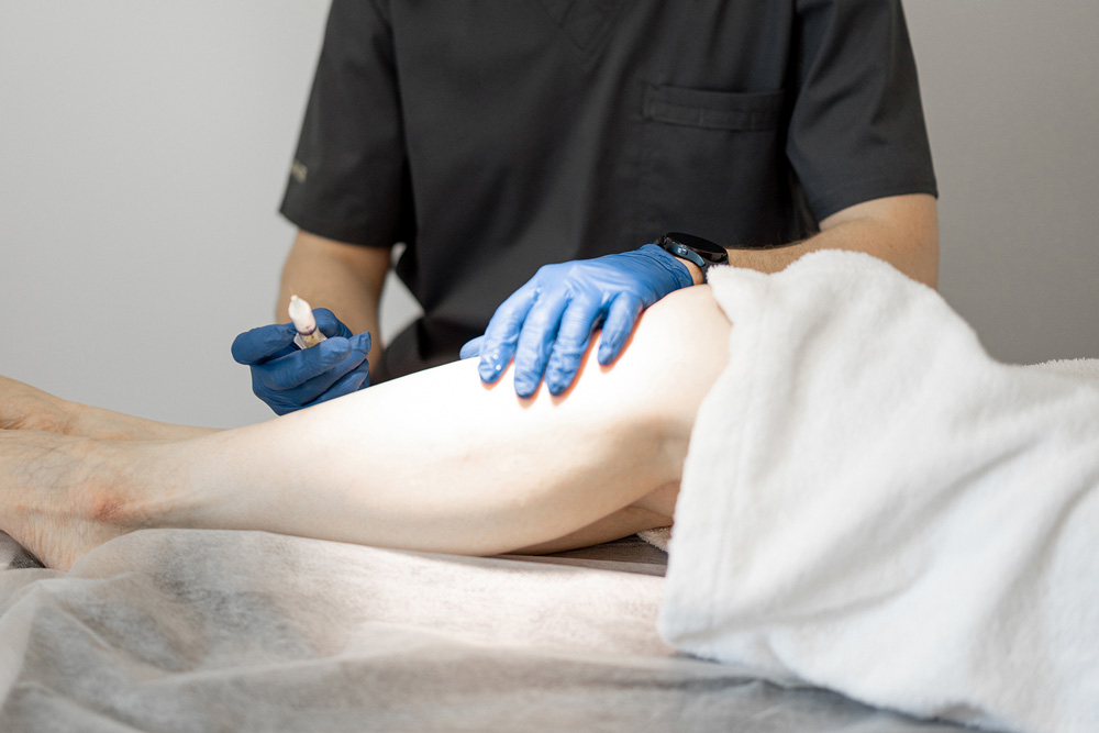 Sclerotherapy Side Effects