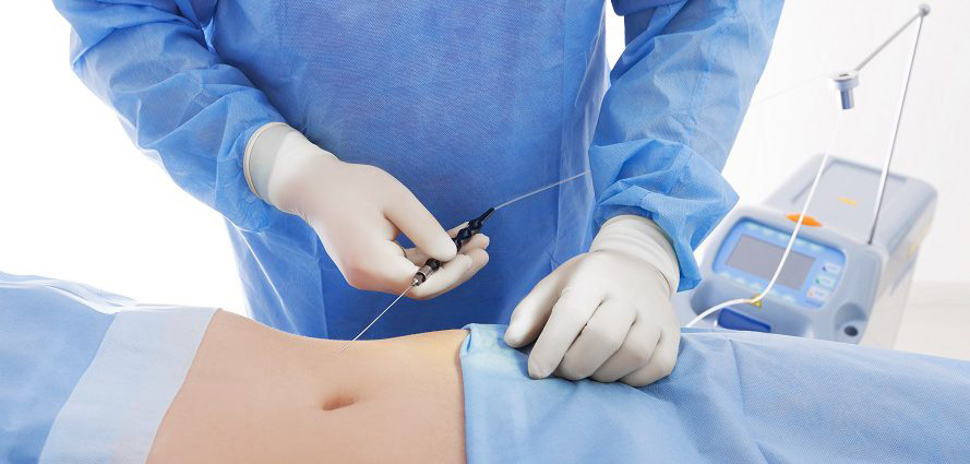 Smart Lipo Mechanism