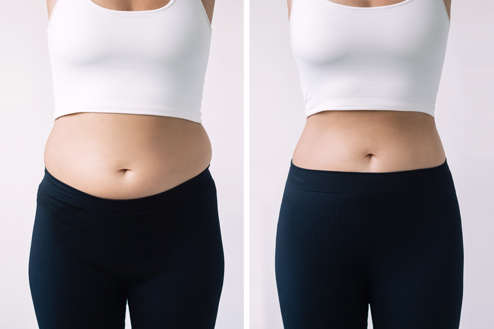 Smart Lipo vs CoolSculpting