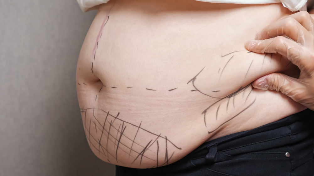 Smart Liposuction