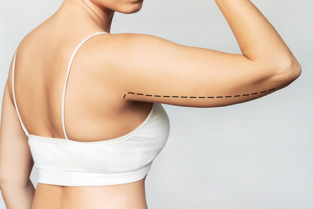 What Is Arm Liposuction
