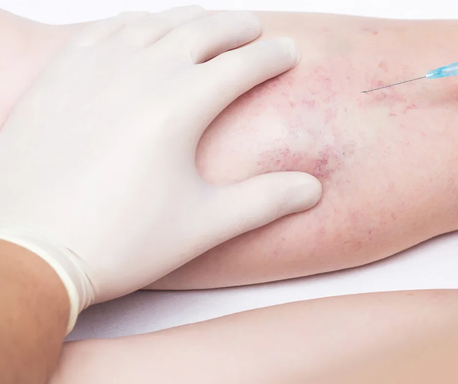What Is Sclerotherapy