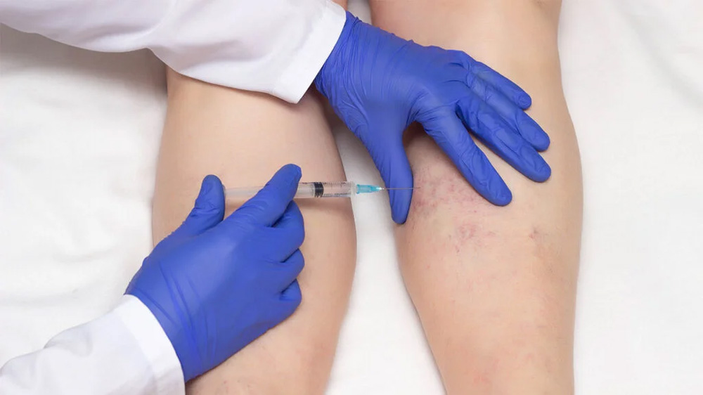 What Is Sclerotherapy and How Does It Work
