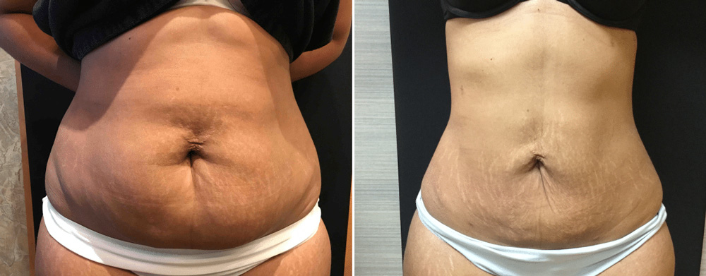 What Smart Lipo Actually Does