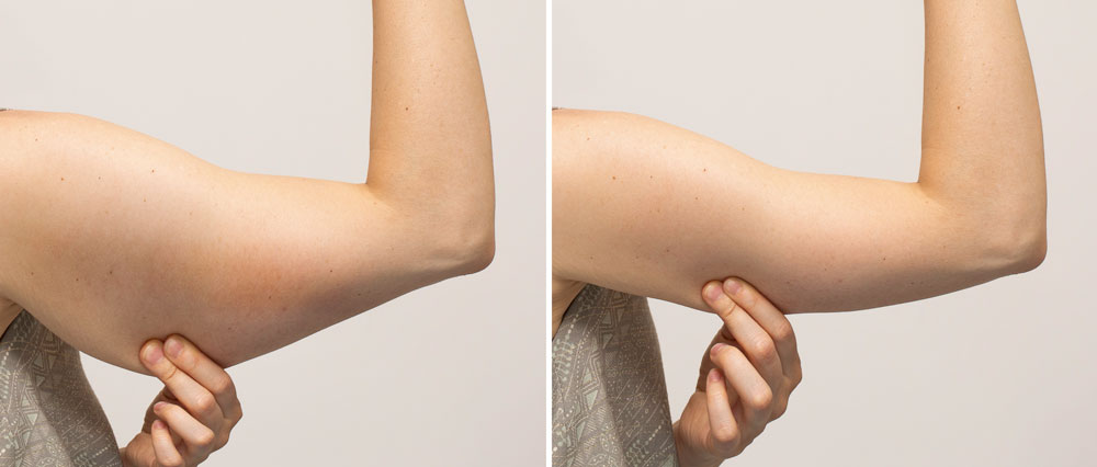 Before & After: What Kind of Results Can You Expect?