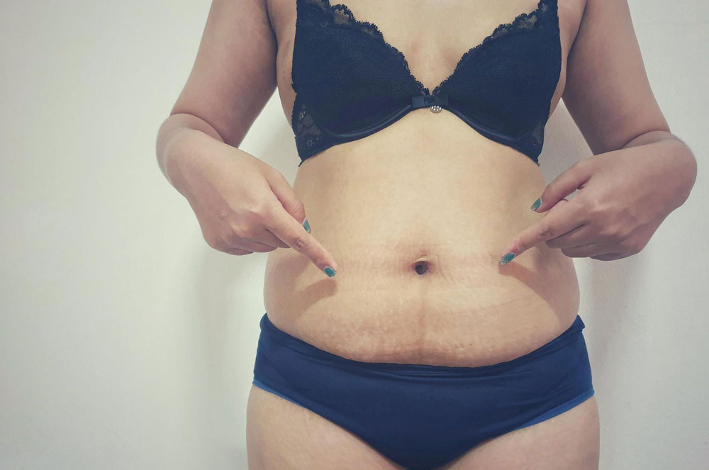 Common Risks and Side Effects of Liposuction