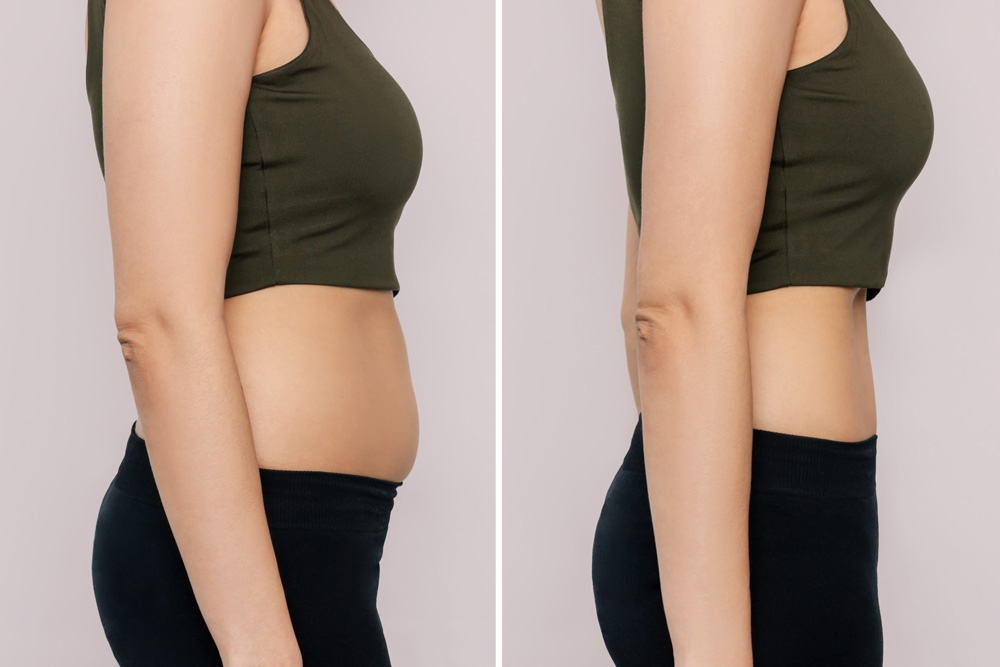 Differences Between Smart Liposuction and Traditional Liposuction