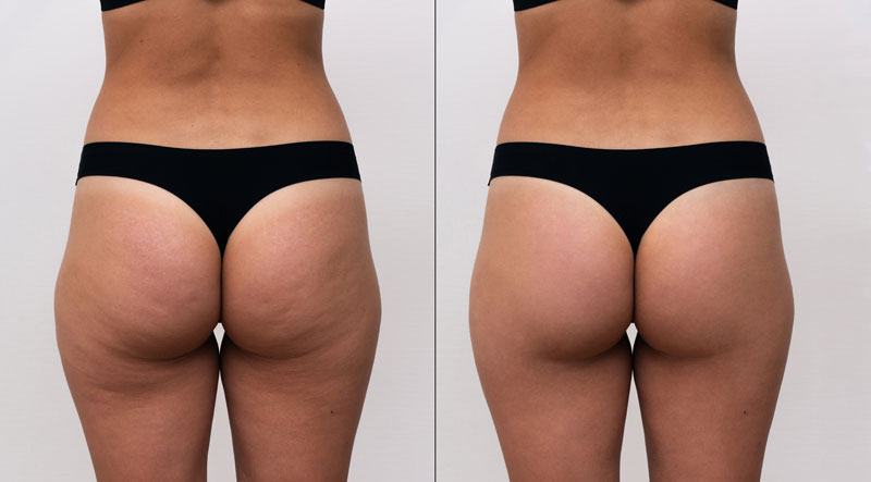 Does Liposuction Help With Cellulite? The Real Answer