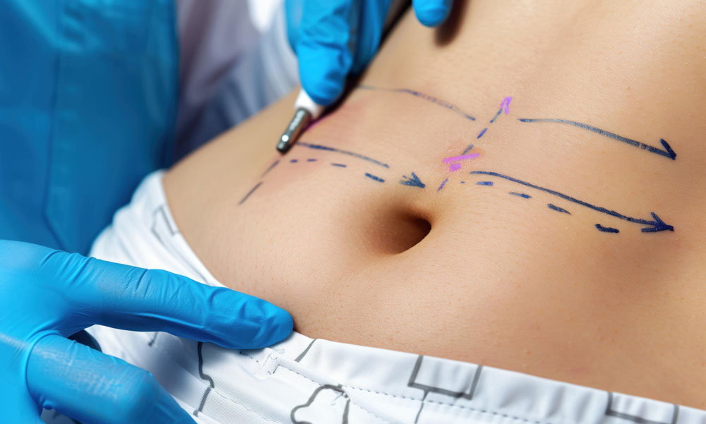 Experience Minimally Invasive Smart Liposuction at Perizia Aesthetics