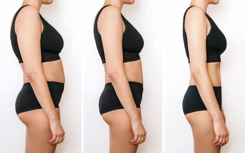 Laser Liposuction Recovery Timeline: What to Expect Day-by-Day