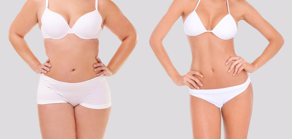 Recovery and Expected Results After Laser Liposuction