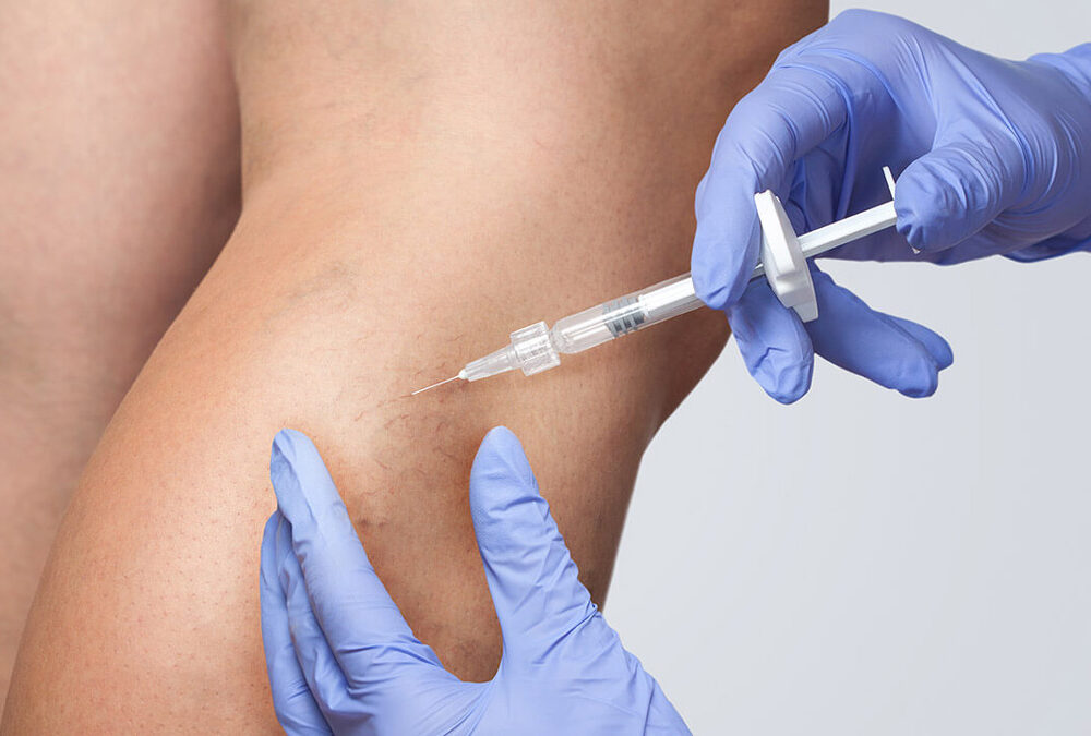 Sclerotherapy vs. Laser Vein Removal