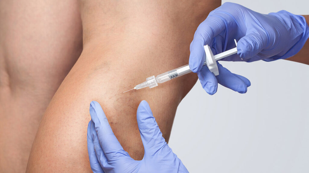 Sclerotherapy vs. Laser Vein Removal