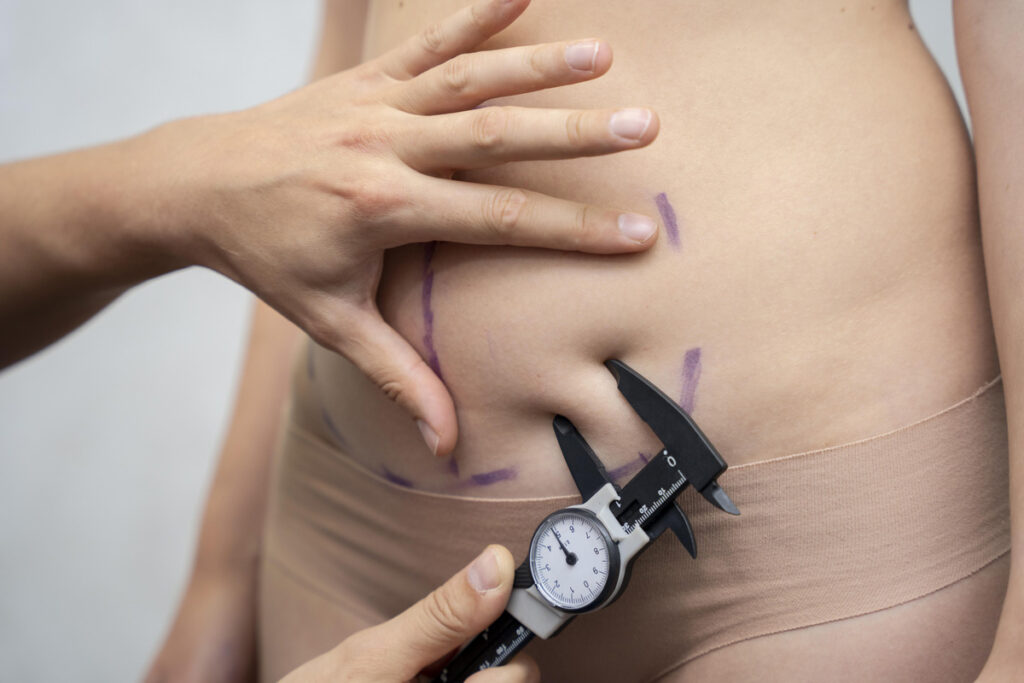 Smart Liposuction vs. Traditional Liposuction