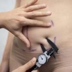 Smart Liposuction vs. Traditional Liposuction