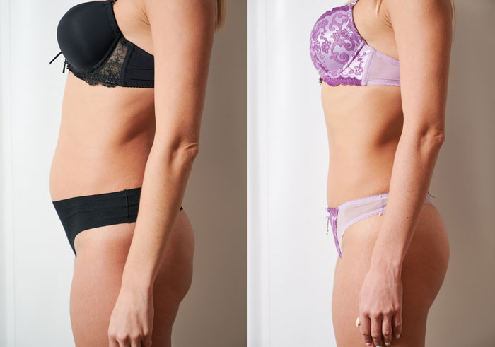 The Benefits of Liposuction