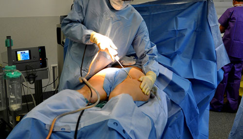 Ultrasound Assisted Liposuction (VASER)