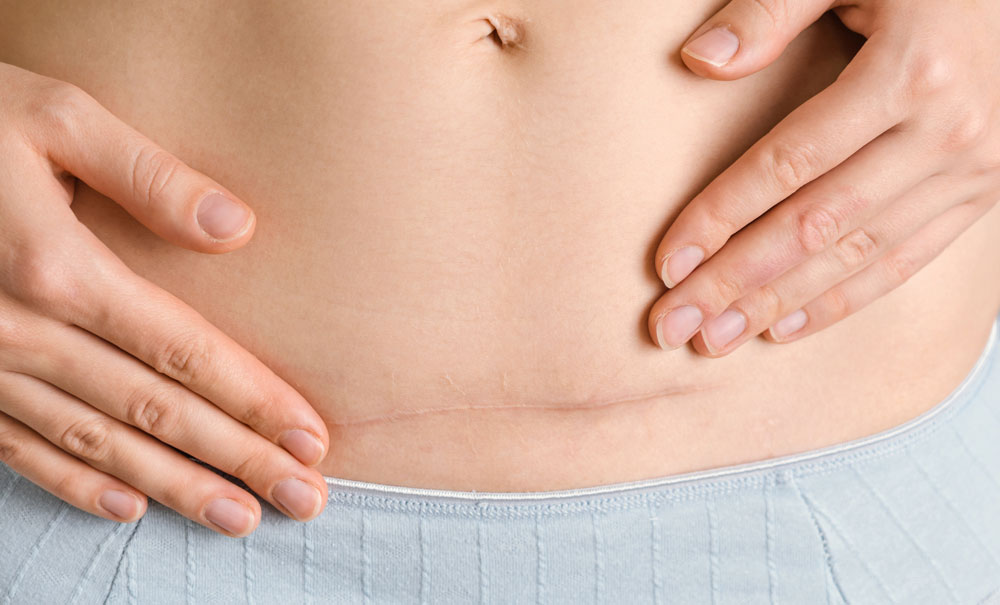 Understanding Scars and How They Form