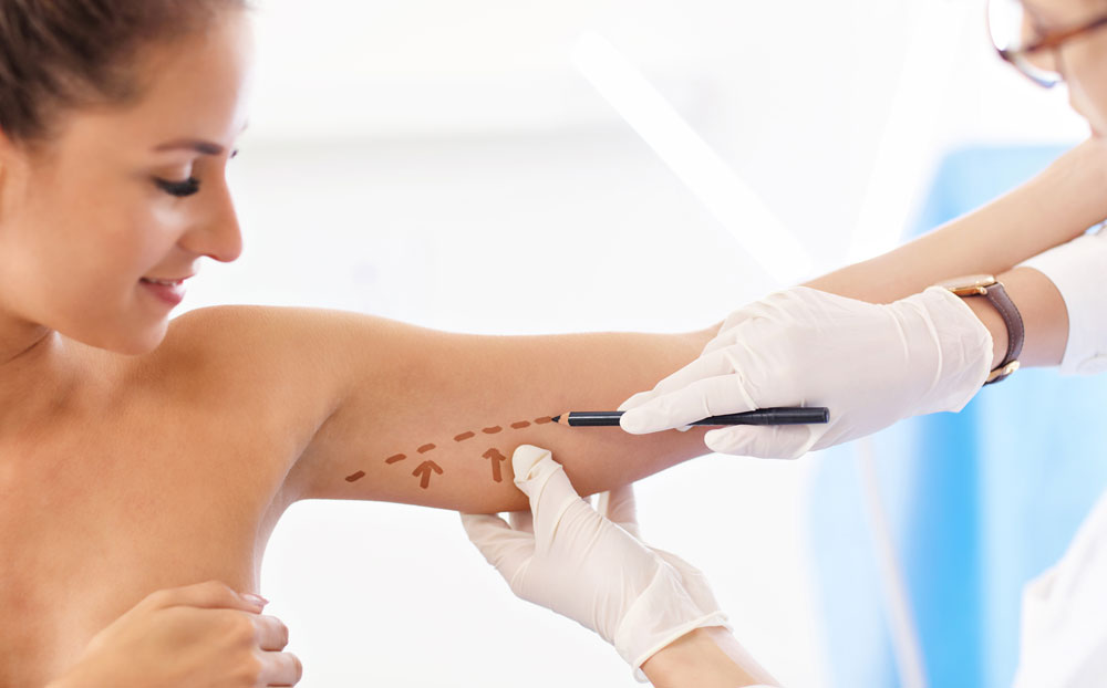 What Is Arm Liposuction and How Does It Work?