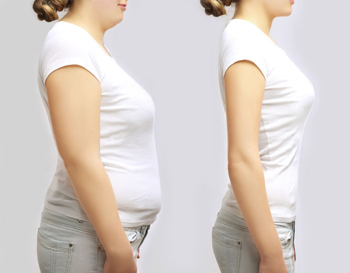What Is Liposuction?