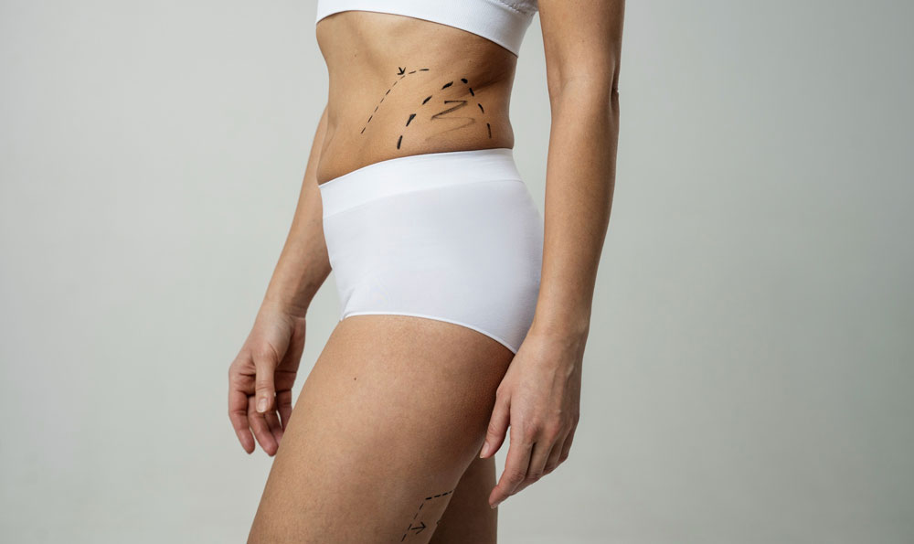 What Is Minimally Invasive Smart Liposuction?