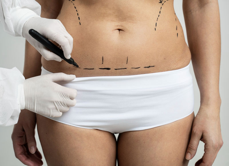 What Makes a Good Candidate for Minimally Invasive Liposuction?