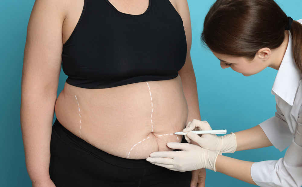 Who Is a Good Candidate for Liposuction?